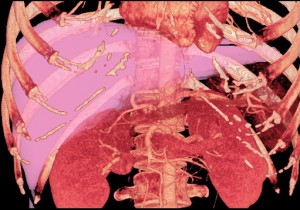 Volume rendering image created with computed tomography which can be used to evaluate the volume of the liver of a potential donor (Photo from Taichung Veterans General Hospital) 